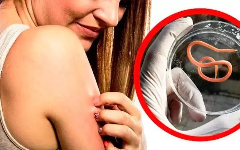 svědění a podráždění způsobené parazity v těle