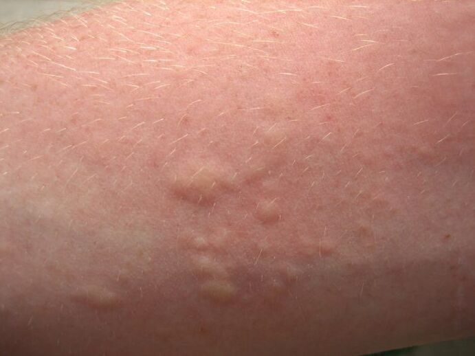 svědivé alergické kožní vyrážky mohou být příznaky ascariázy