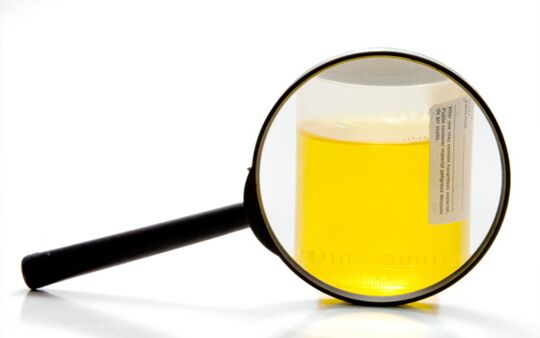 Vyšetření moči k diagnostice schistosomiázy