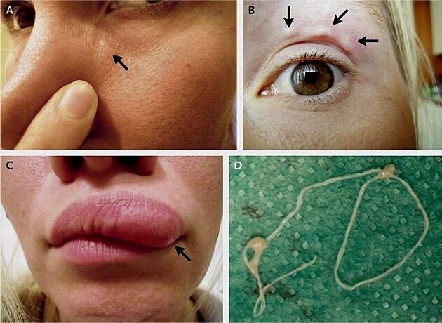 Hlavní projevy dirofilariázy na obličeji