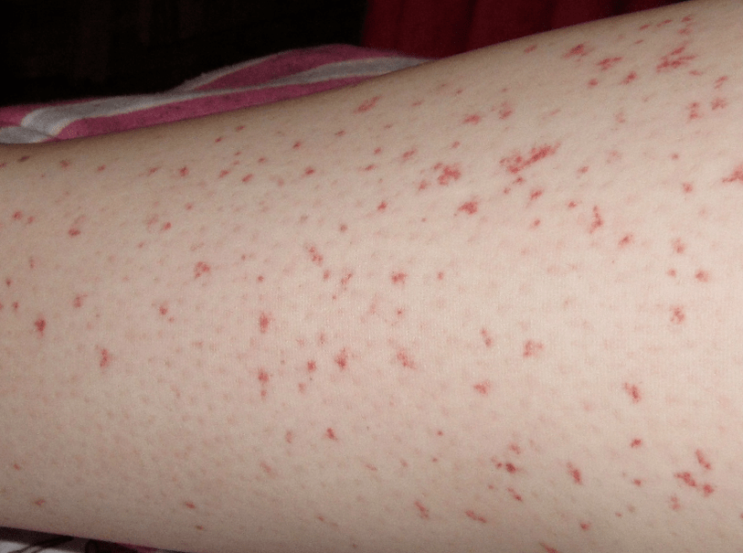 Kožní vyrážka je známkou akutního stádia červové infekce